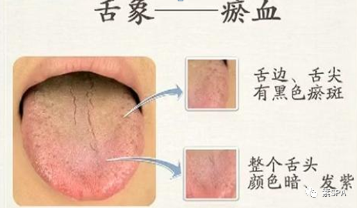 Traditional Chinese Medicine: The Root of All Illnesses is Blood Stasis