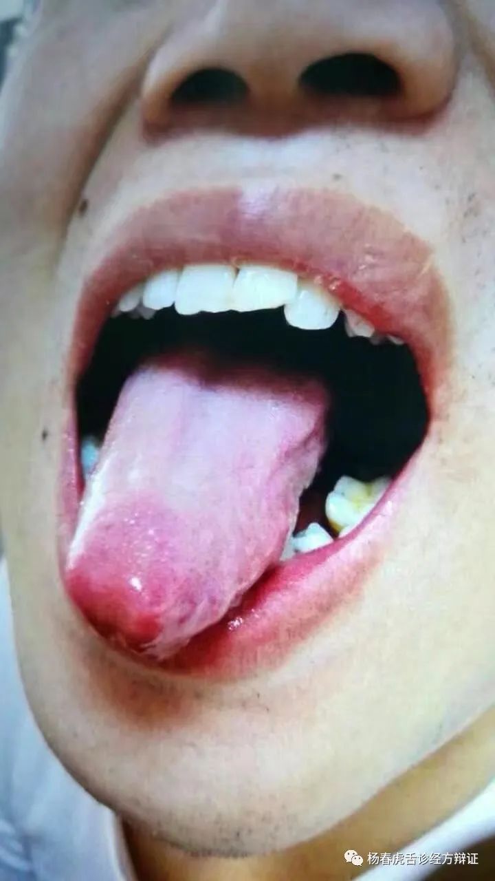 Foundations of Traditional Chinese Medicine: Phlegm-Dampness