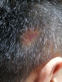 The Treasure of TCM in Treating Alopecia Areata