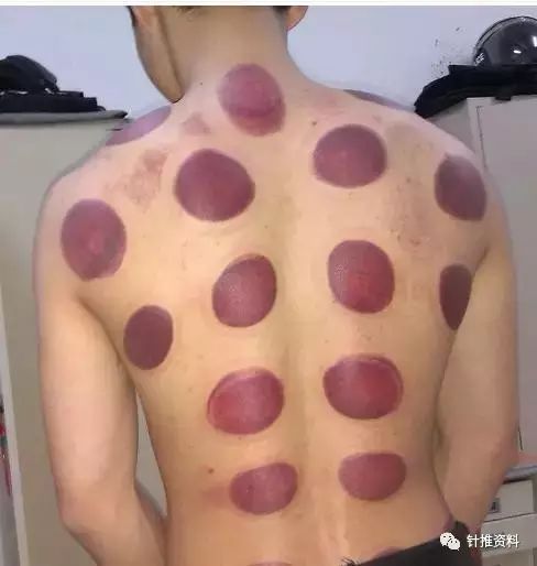 The Techniques and Diagnosis of Cupping Therapy in Traditional Chinese Medicine