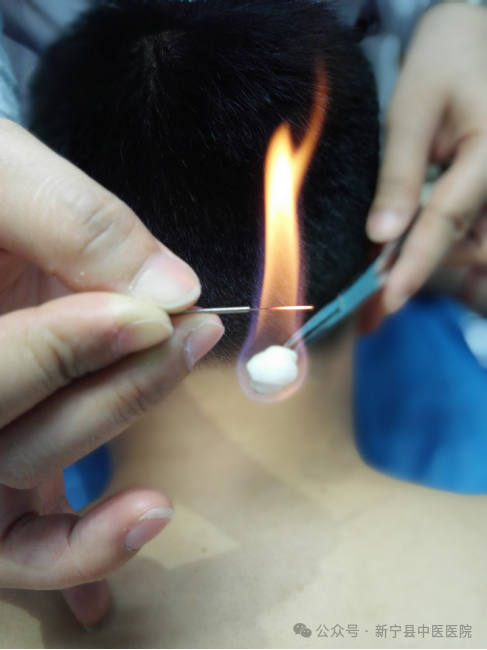 The Hidden Power of a Small Needle: The Miraculous Moxibustion Fire Needle Therapy