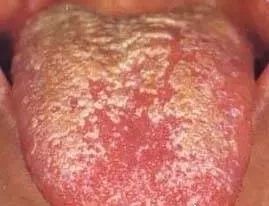 Understanding Tongue Diagnosis in Traditional Chinese Medicine (with Tongue Diagnosis Illustrations)