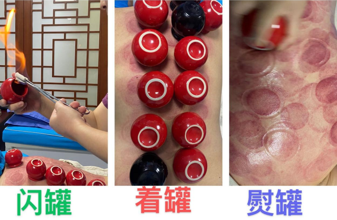 New Technique: The 'Leopard Spot' Cupping Therapy You Didn't Know About