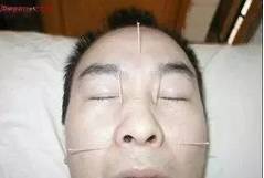 The Miraculous "Three Needles" in TCM Acupuncture: Treating One Disease with Three Acupuncture Points