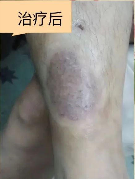 Dermatology: TCM Fire Needle Technique for Treating Skin Diseases