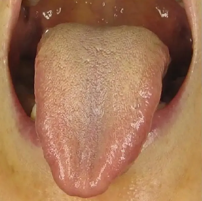 When Your Tongue Shows This Signal: Go to the Hospital Immediately, Don't Delay!
