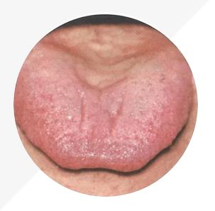 Understanding Tongue Diagnosis in TCM: Insights into Health from Tongue Appearance (Part 2)