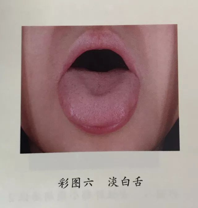 Deficiency of Qi and Blood: Pale Tongue Diagnosis