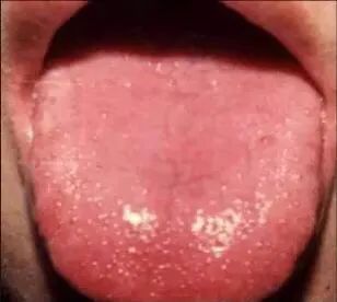 Tongue Diagnosis - Illustrated Guide to Tongue Manifestations