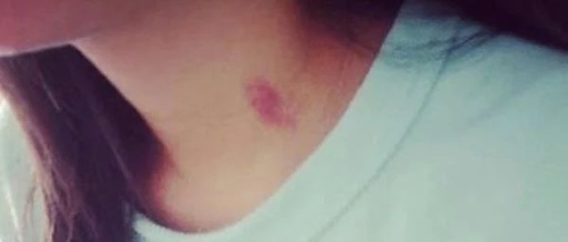 Can Gua Sha and Cupping Treat Illness?