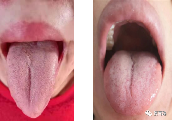 Basic Tongue Diagnosis - Tongue Body and Tongue Coating