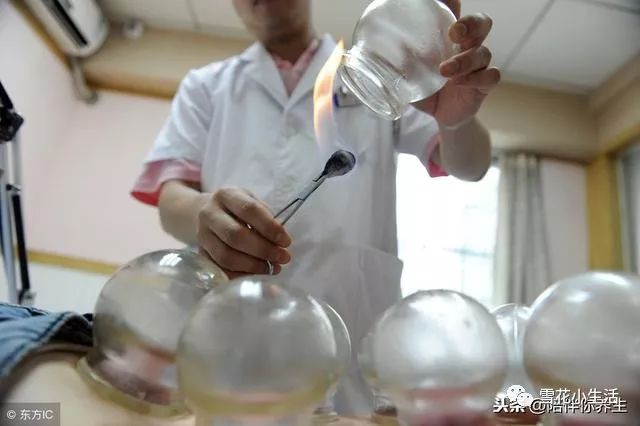 Is Cupping Good? TCM and Western Medicine Warn: This Way of Cupping Could Shorten Your Life, Please Be Aware!