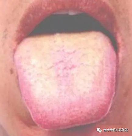 Tongue Diagnosis in Traditional Chinese Medicine: Tongue Coating