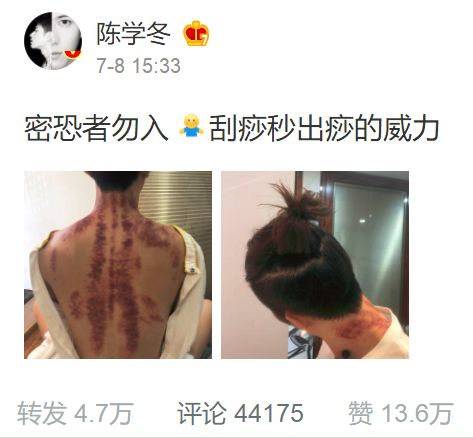 Chen Xuedong Shares His Gua Sha Experience: Experts Warn Against Incorrect Techniques That May Harm Kidney Function!