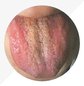 Understanding Tongue Diagnosis in TCM: Insights into Health from Tongue Appearance (Part 2)