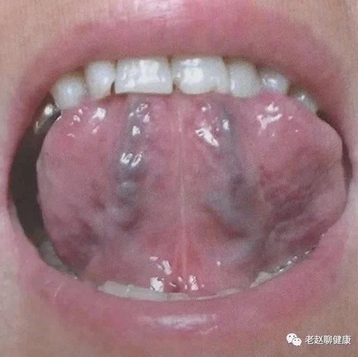 Tongue Diagnosis │ Sublingual Collaterals