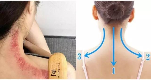 Conditions That Can Be Alleviated by Gua Sha