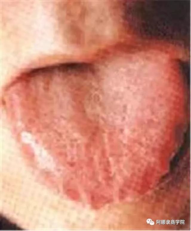 A Comprehensive Guide to 22 High-Definition Tongue Diagnosis Images: Understand Diseases Through Tongue Observation!