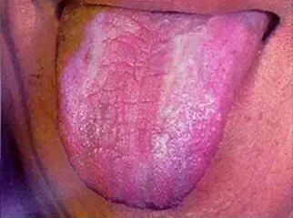 Tongue Diagnosis - Illustrated Guide to Tongue Manifestations