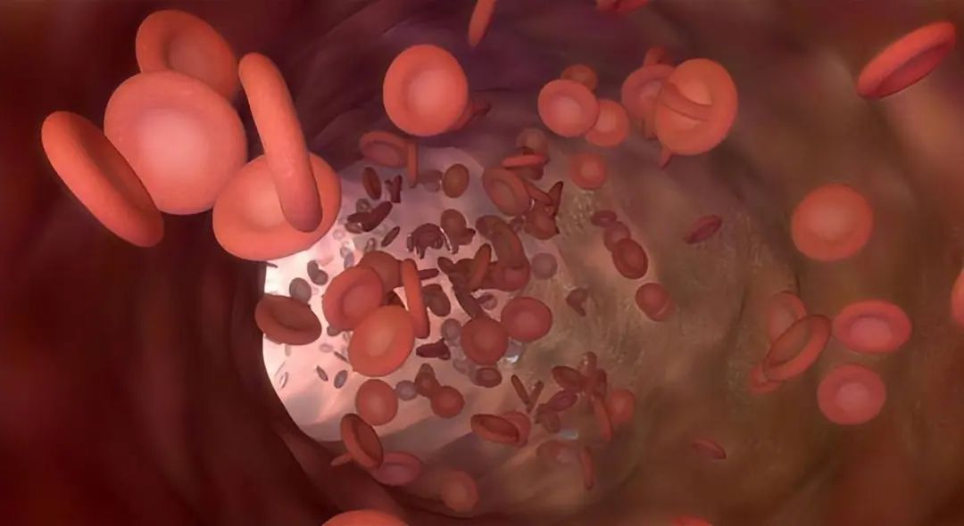 Understanding Blood Stasis: Key Points to Consider for Effective Treatment