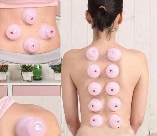 Cupping Therapy in Traditional Chinese Medicine: Meaning, Functions, Contraindications, and Precautions