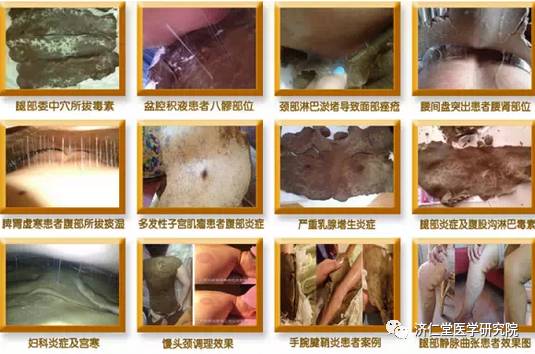 Understanding the Six Evils in Traditional Chinese Medicine