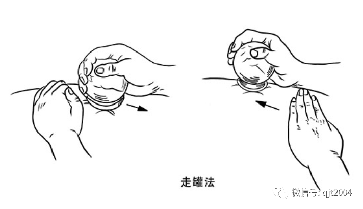 Does Not Producing Sha After Cupping Indicate Ineffectiveness? Key Insights on Cupping Therapy