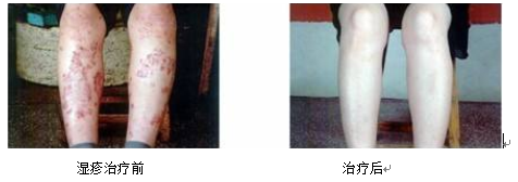 Fire Needle Therapy for Skin Diseases: Visible Safety and Efficacy