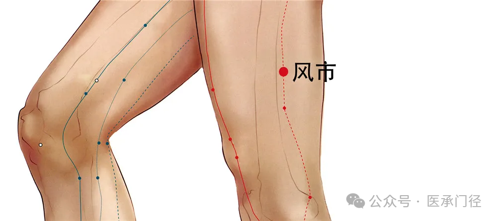 Traditional Fine Needle Technique for Acupuncture Treatment of Sciatica