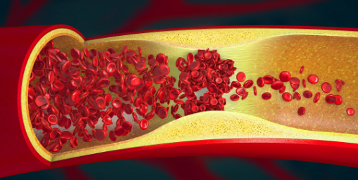 Vascular Stenosis: No Need for Stents, A Formula to Promote Blood Circulation and Clear Blockages!