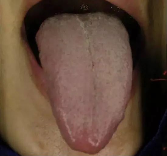 Tongue Diagnosis - Illustrated Guide to Tongue Manifestations