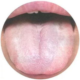 Observing Tongue Coating to Assess Health: A Summary of Classic Tongue Signs in Traditional Chinese Medicine