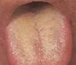 Four Tongue Coating Colors Revealing Your Body Condition