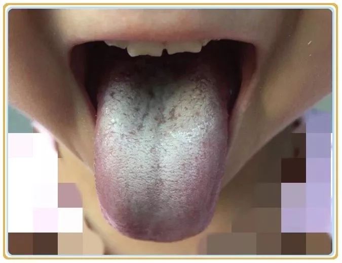 Tongue Diagnosis | Why is the Tongue Coated?