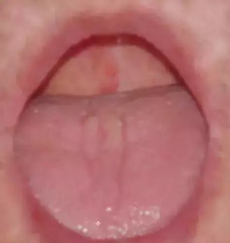 The Most Comprehensive Guide to Tongue Diagnosis! Master It and Become a Tongue Diagnosis Expert