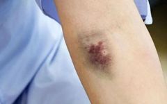 The Ultimate Method to Resolve Blood Stasis: Warming Yang and Smoothing the Liver! A Two-Step Approach from Traditional Chinese Medicine