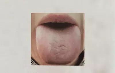 Exploring the Secrets of the Body Through Tongue Diagnosis