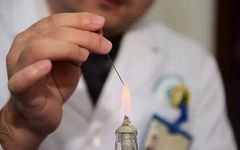 Traditional Chinese Medicine: Fire Needle Therapy