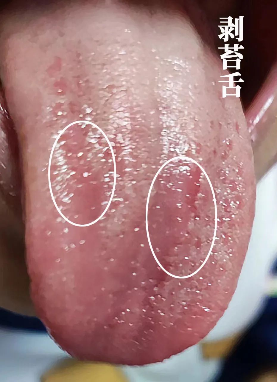 The Body Signals Illness: Understanding Tongue Diagnosis in TCM