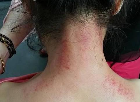 Benefits and Effects of Gua Sha on the Shoulders and Neck