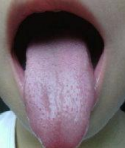 Understanding the Implications of a Thin Yellow Coating on the Tongue in TCM