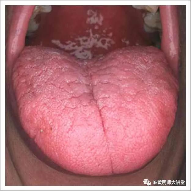 Traditional Chinese Medicine Tongue Diagnosis: Illustrated Guide to 14 Types of Tongue Shapes and Qualities