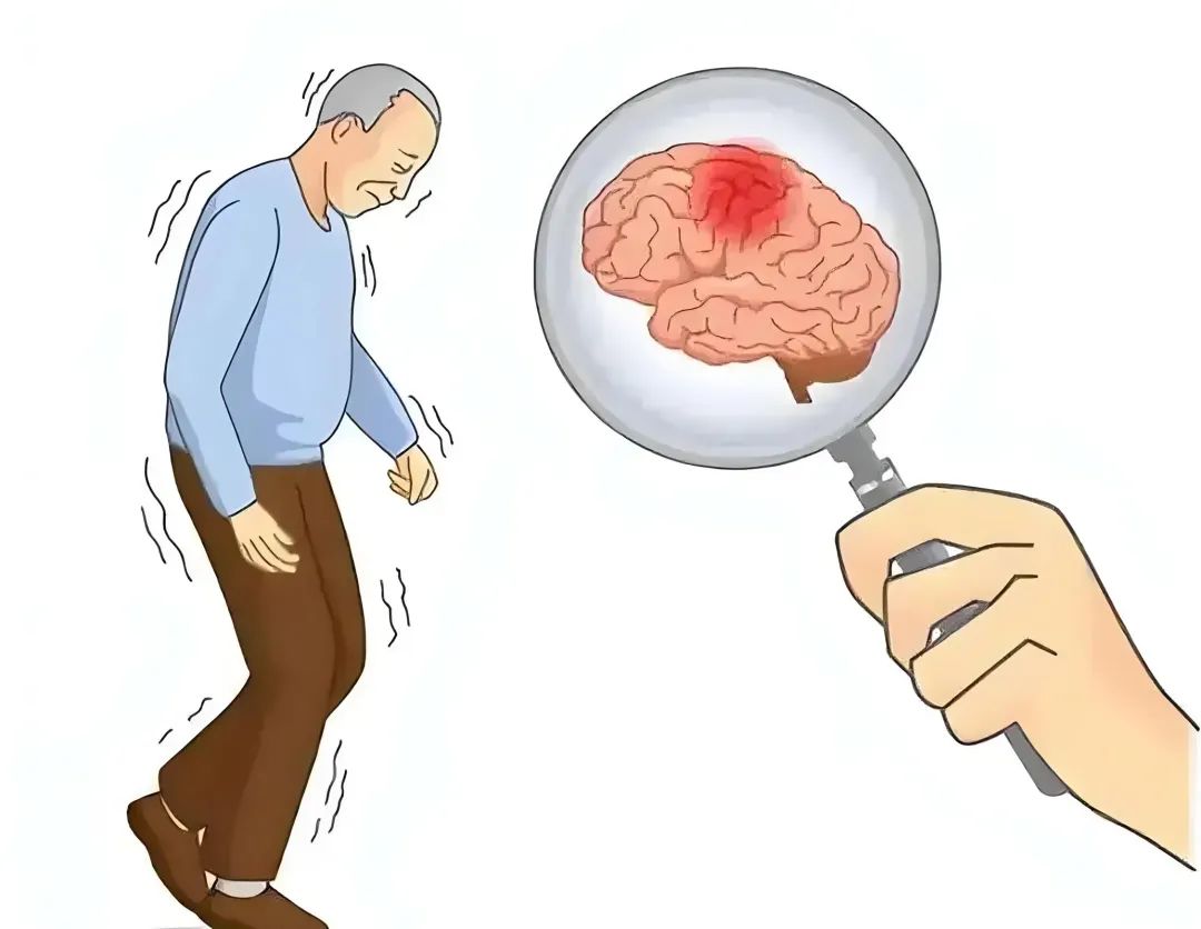10 Treatment Plans for Cerebral Infarction: Effectively Activating Blood Circulation, Resolving Stasis, Nourishing Nerves, and Improving Sequelae