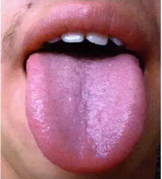Five Key Points of Tongue Diagnosis in Traditional Chinese Medicine