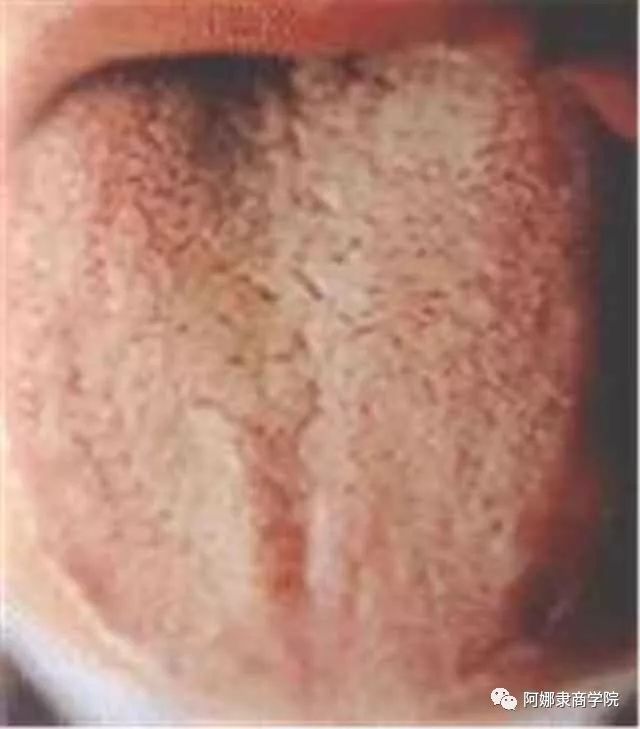 A Comprehensive Guide to 22 High-Definition Tongue Diagnosis Images: Understand Diseases Through Tongue Observation!