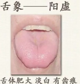 Comprehensive Guide to Tongue Diagnosis (Tongue Manifestations)