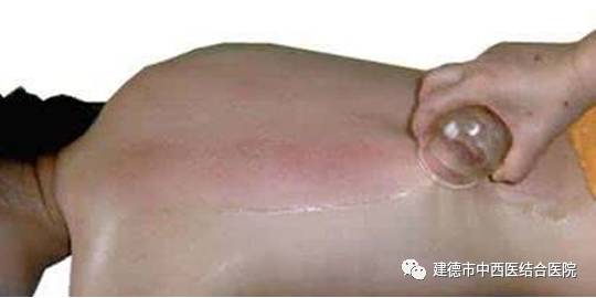 Cupping Therapy in Summer: An Effective Method to Eliminate Dampness, Relieve Heat, and Drive Away Cold