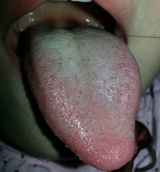 High-Definition Tongue Diagnosis Atlas for Children: Understanding Tongue Diagnosis (A Must-Collect)