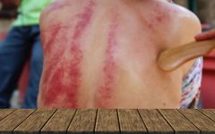Does Excessive Gua Sha Deplete Your Energy? Self-Diagnosis Through Gua Sha for Early Health Awareness!