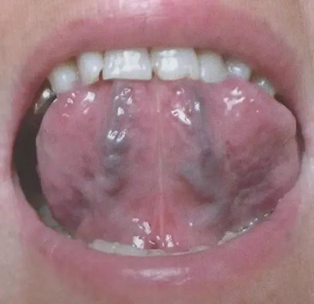 Understanding the Sublingual Collaterals in Traditional Chinese Medicine